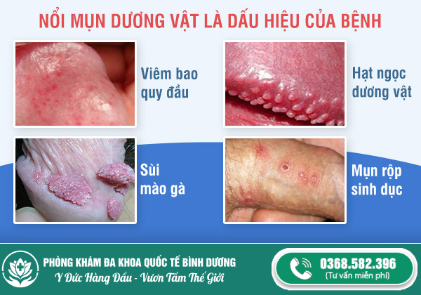 nổi mụn dương vật là bệnh gì