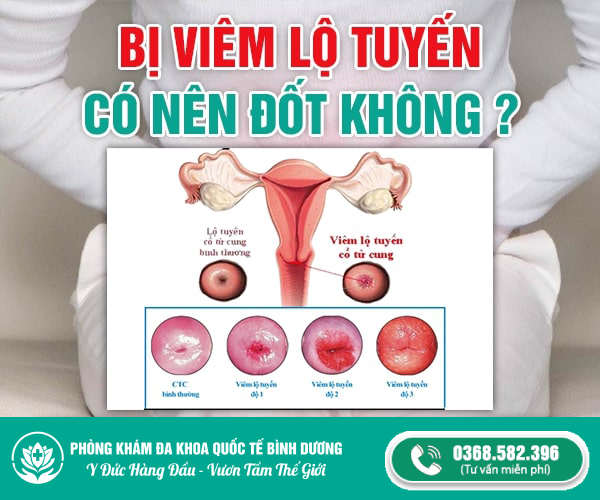 viêm lộ tuyến có nên đốt không