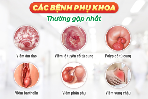 bệnh viêm phụ khoa thường gặp